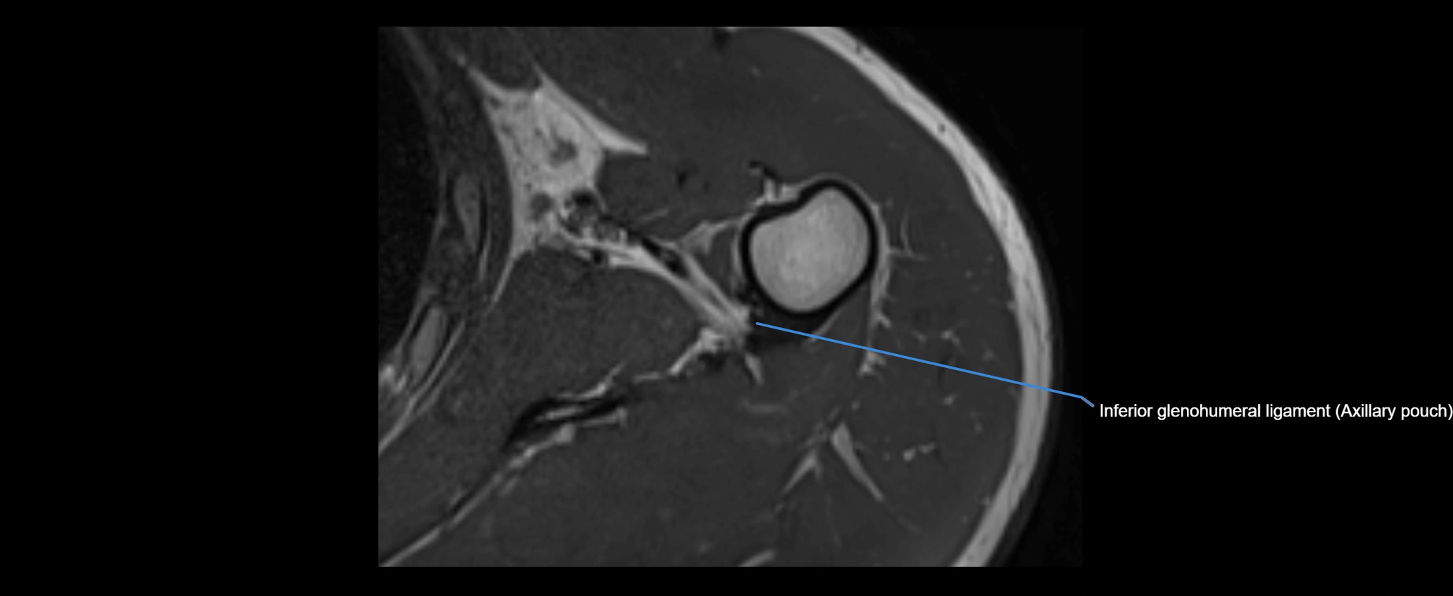 shoulder ligaments axial 3d 3t mri image-img-00005-00094.webp